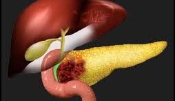 cancern_pangreas