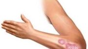 psoriasi_diavitis2