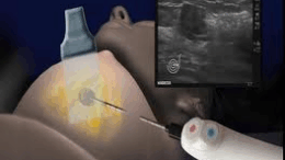 pagomeni_methodos_exolothrevei_ton_karkino