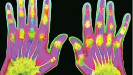 freno_sthn_revmatoeidi_arthritida