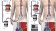 Ecmo