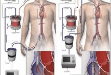 Ecmo