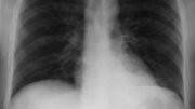 pneumonia