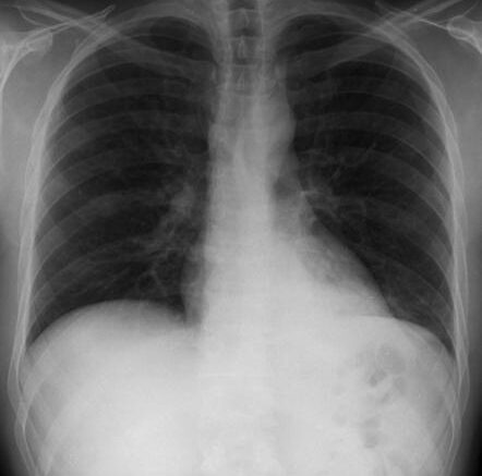 pneumonia