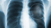 karkinos_pneumona